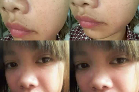 Feedback trị tàn nhang bẩm sinh của Thảo Dược Hồng Hạnh
